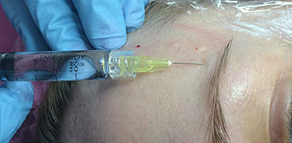 по доступной цене биоревитализация Киев