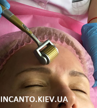 Дермароллер - терапия